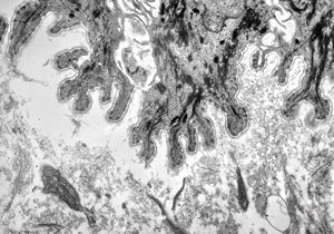 F, 41y. | epidermolysis bullosa … dystrophic type F, 41y. | epidermolysis bullosa … dystrophic type